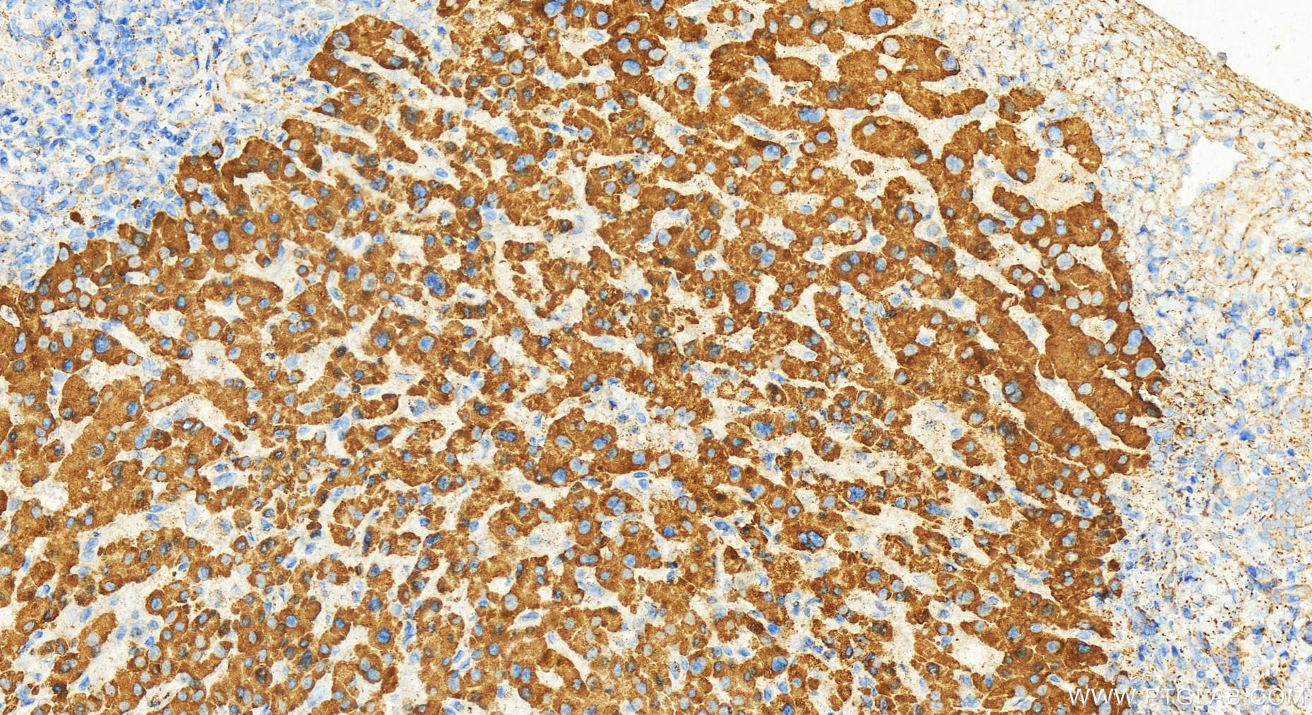 IHC staining of human intrahepatic cholangiocarcinoma using 11862-1-AP