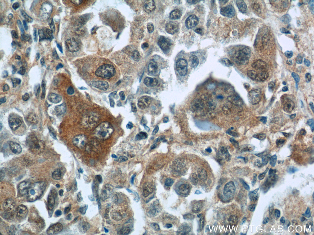 IHC staining of human liver cancer using 11580-1-AP