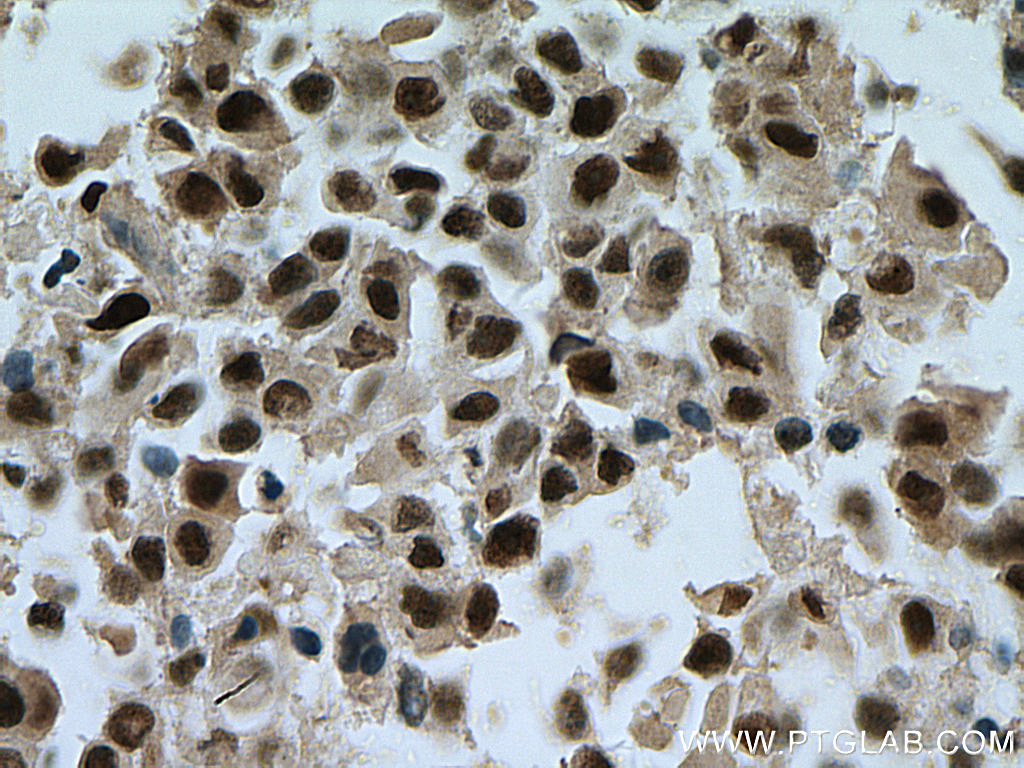 IHC staining of human breast cancer using 16203-1-AP