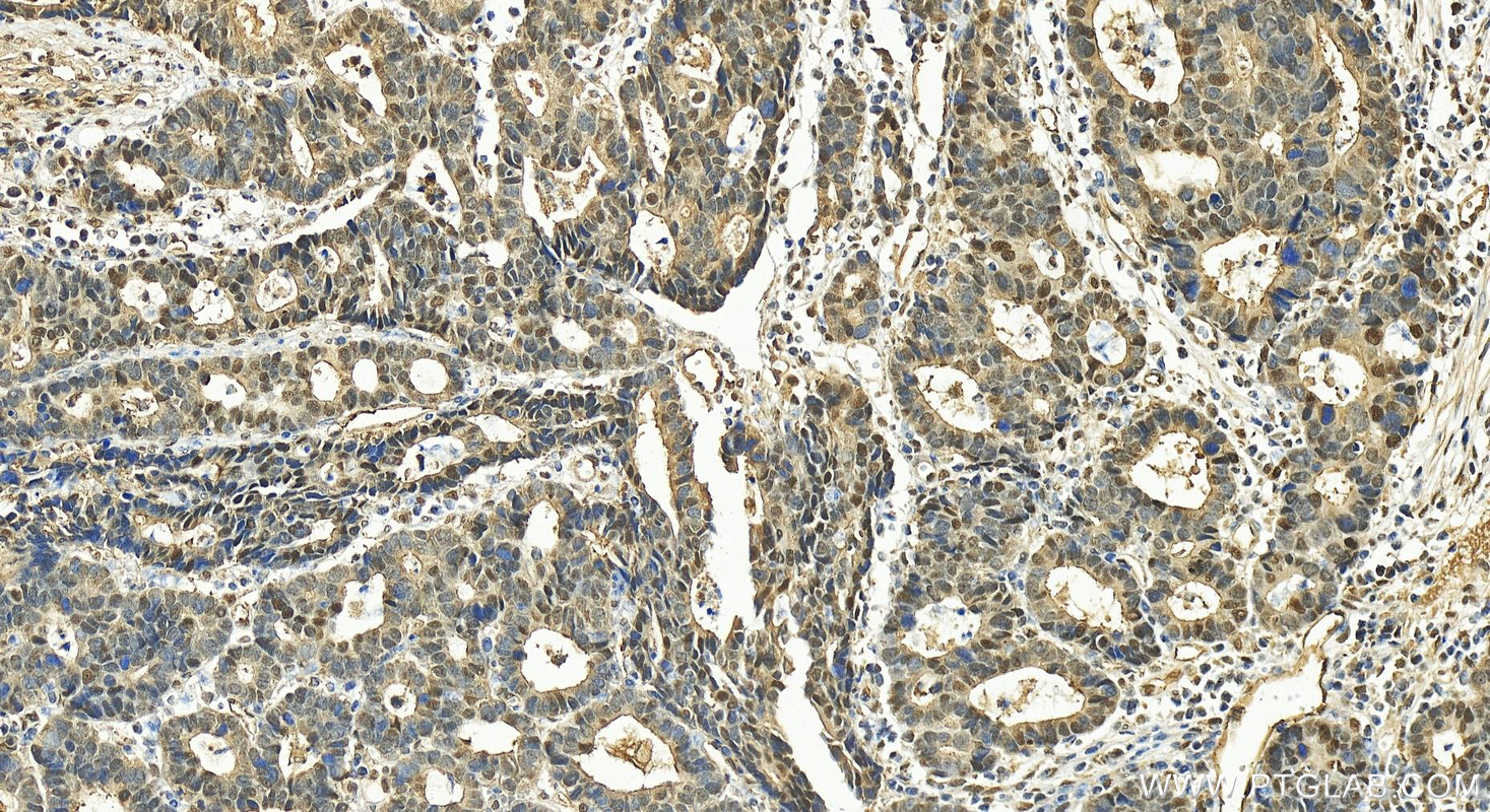 IHC staining of human stomach cancer using 30221-1-AP