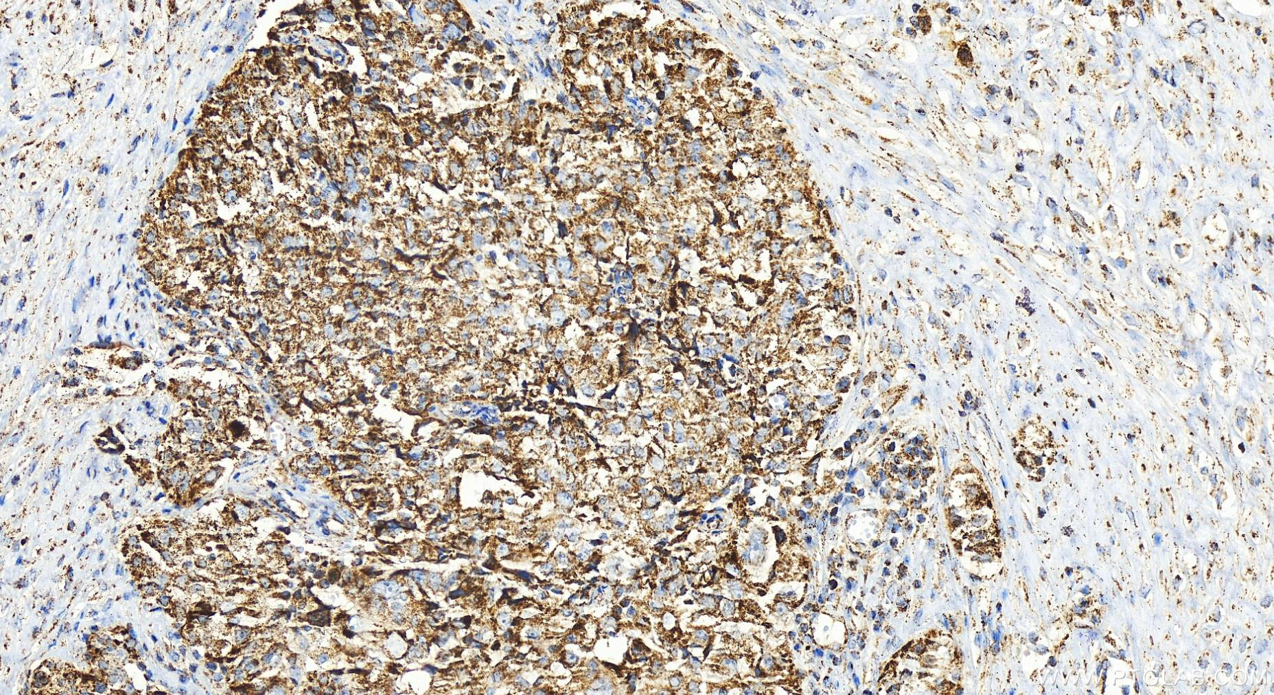 IHC staining of human ovary cancer using 25607-1-AP