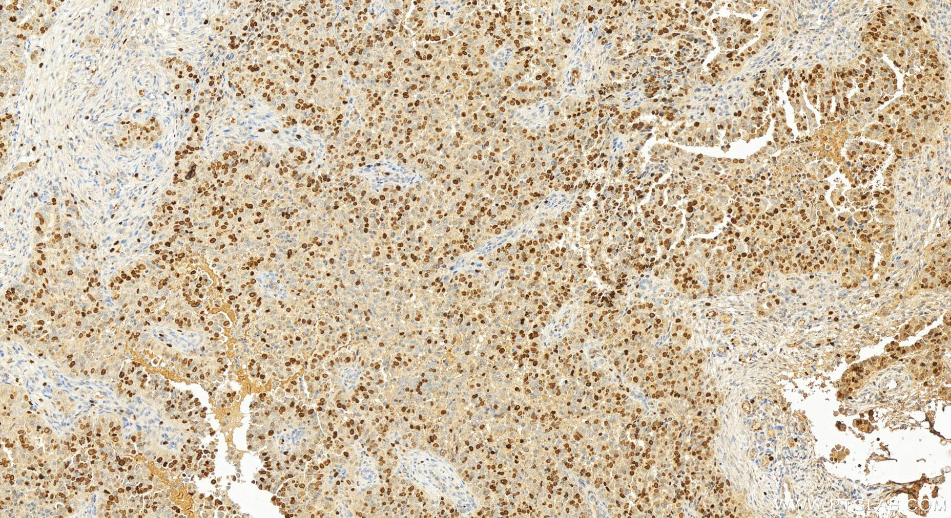 IHC staining of human ovary cancer using 20233-1-AP