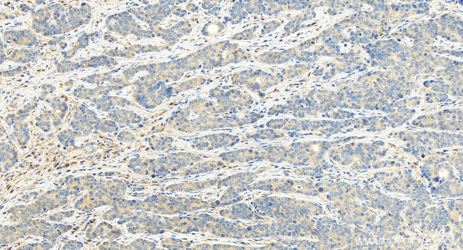 IHC staining of human stomach cancer using 19511-1-AP