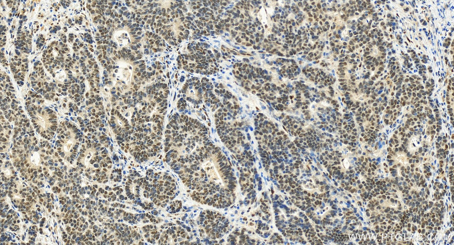 IHC staining of human stomach cancer using 20002-1-AP