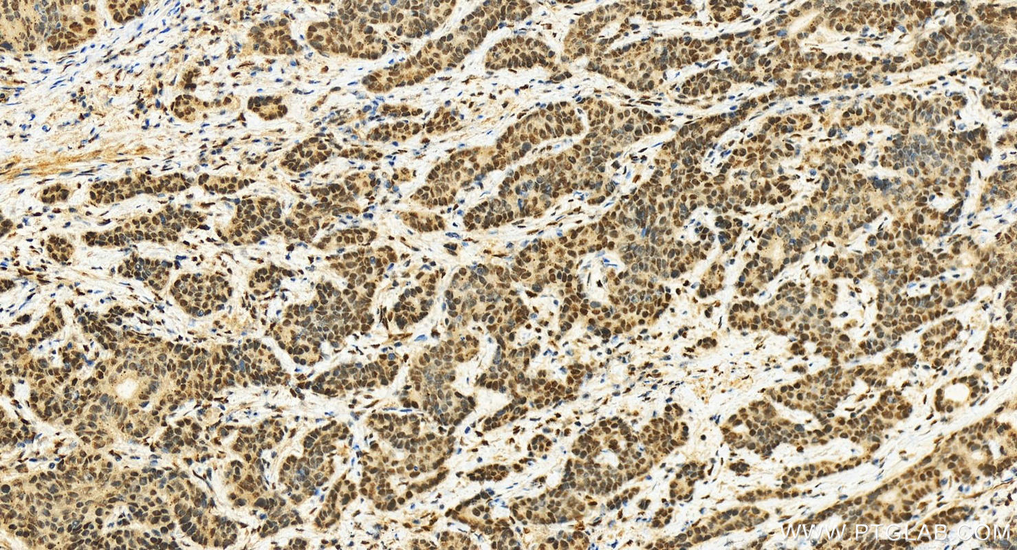 IHC staining of human stomach cancer using 20002-1-AP