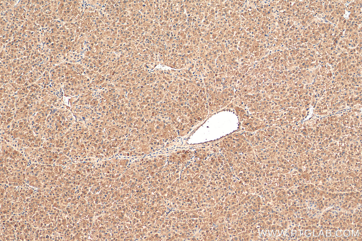 IHC staining of human liver cancer using 17872-1-AP