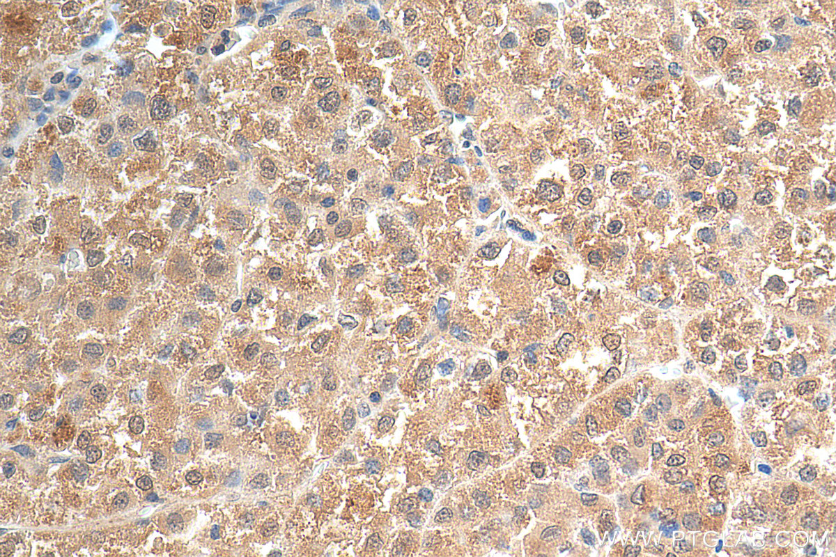 IHC staining of human liver cancer using 17872-1-AP