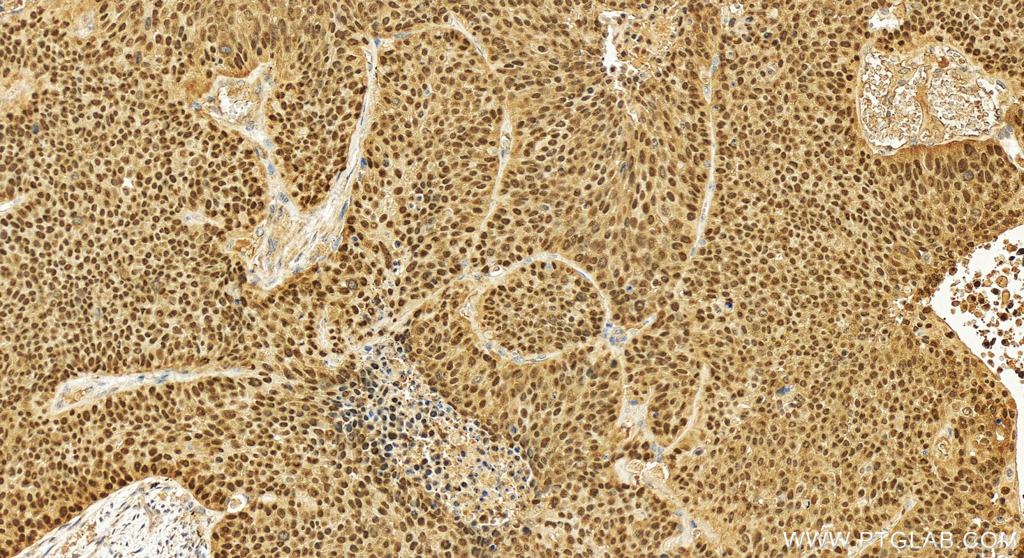 IHC staining of human lung squamous cell carcinoma using 12143-1-AP