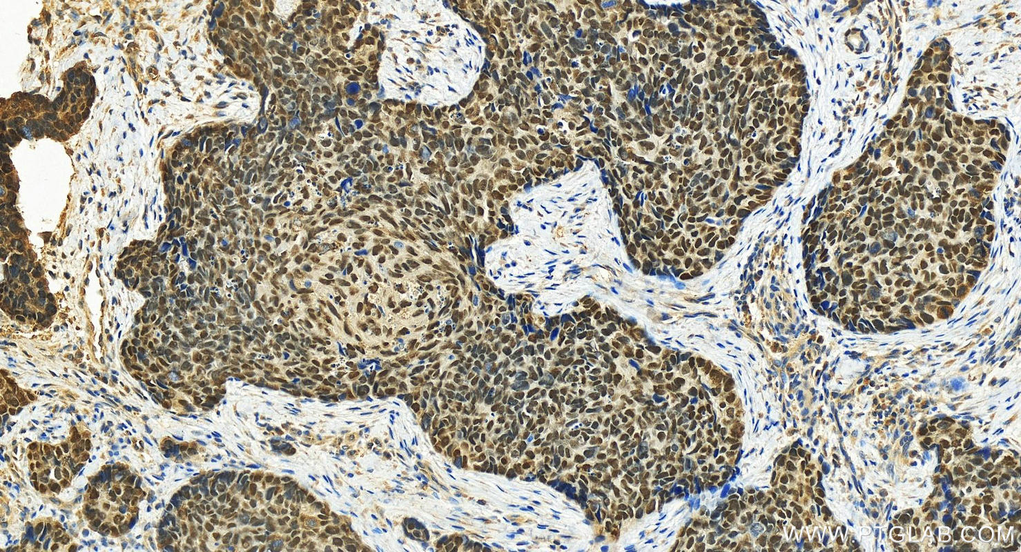 IHC staining of human bowen disease using 12143-1-AP