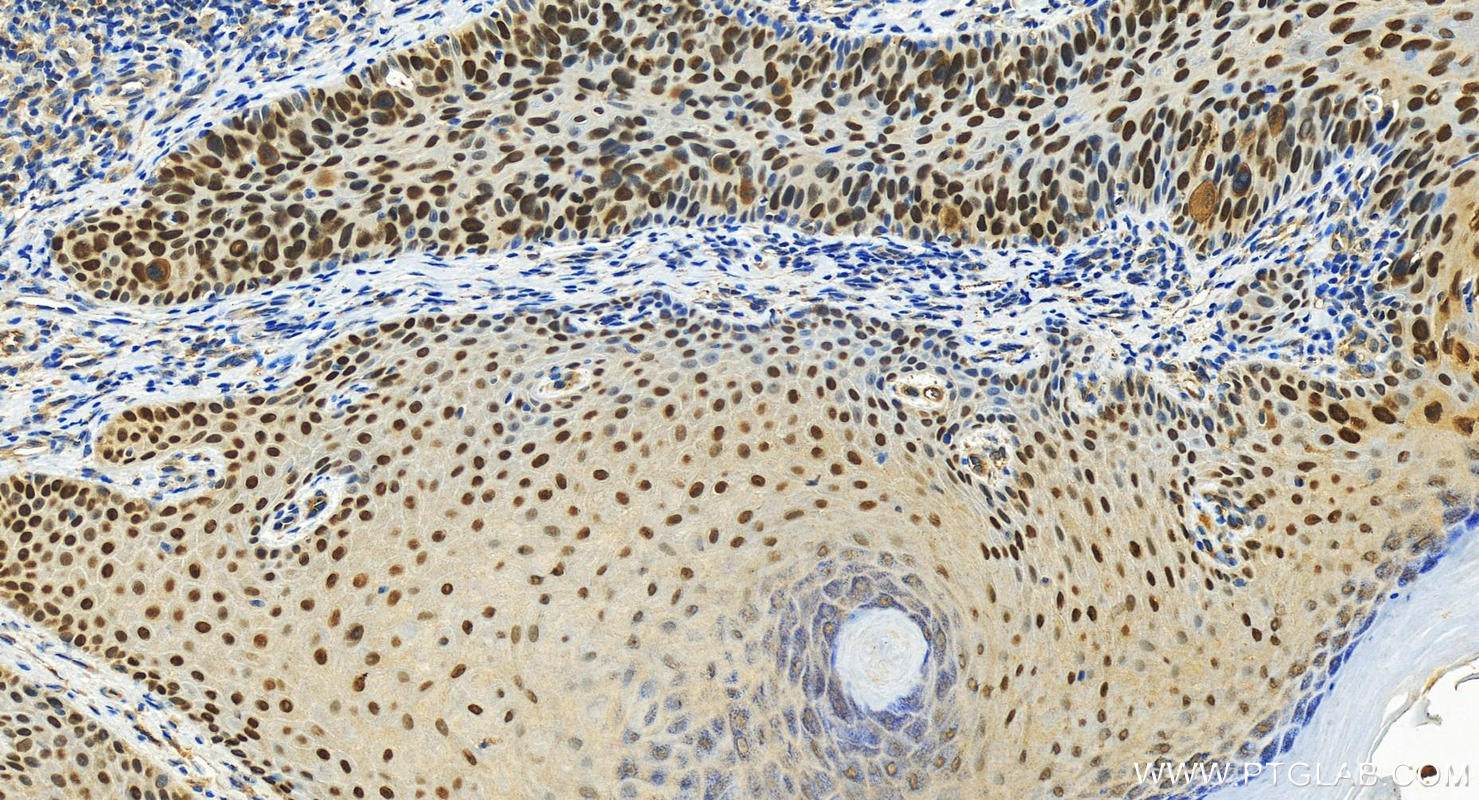 IHC staining of human bowen disease using 12143-1-AP