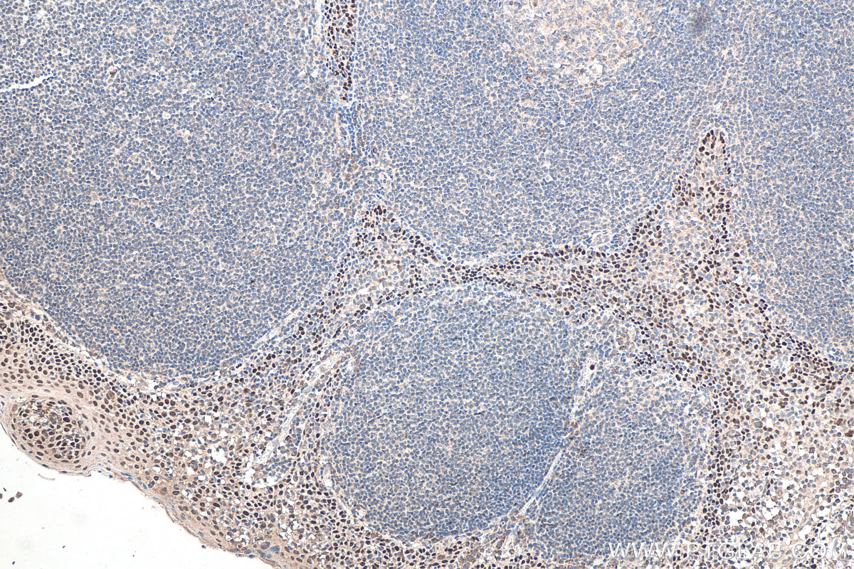 IHC staining of human tonsillitis using 60332-2-Ig (same clone as 60332-2-PBS)