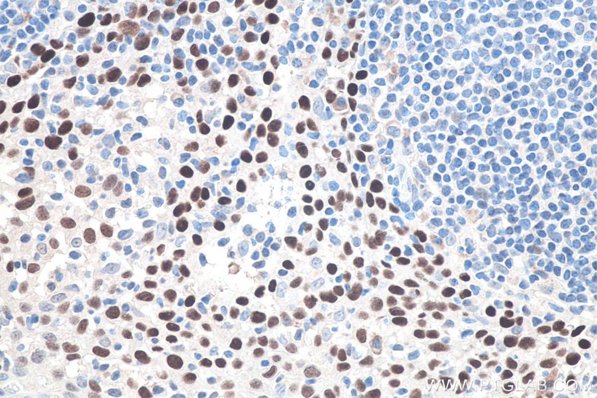 IHC staining of human tonsillitis using 60332-2-Ig (same clone as 60332-2-PBS)