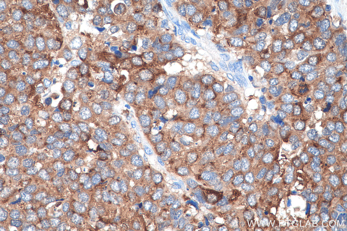 IHC staining of human stomach cancer using 27648-1-AP