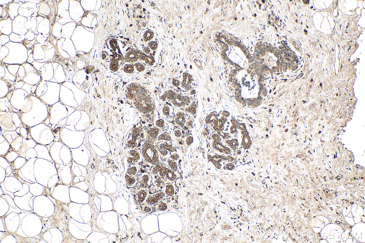 IHC staining of human breast cancer using 68077-1-Ig (same clone as 68077-1-PBS)