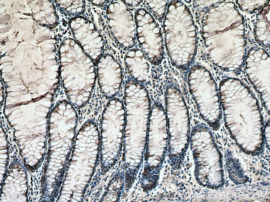 IHC staining of human colon cancer using 67515-1-Ig