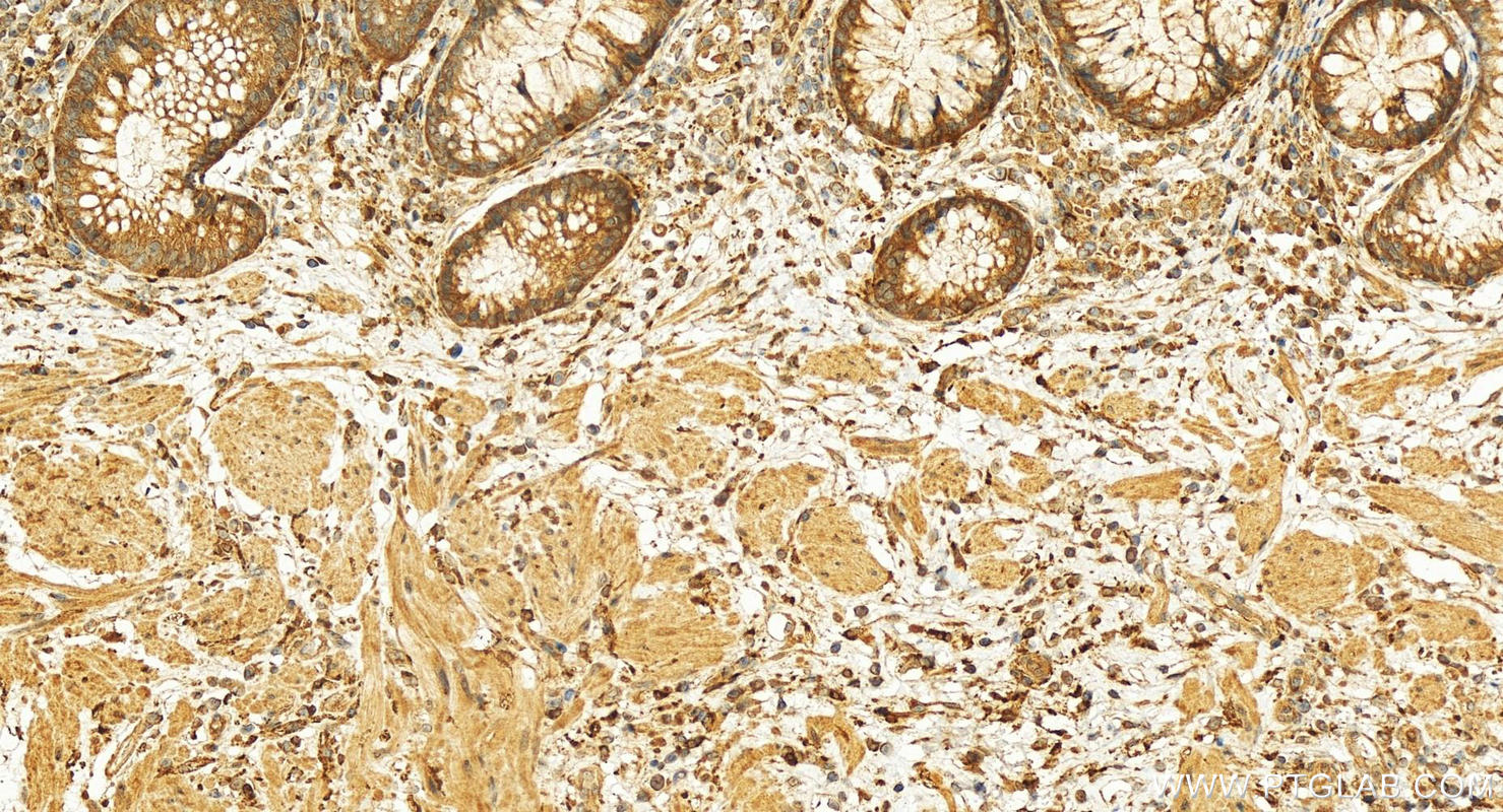 IHC staining of human colon cancer using 10942-1-AP