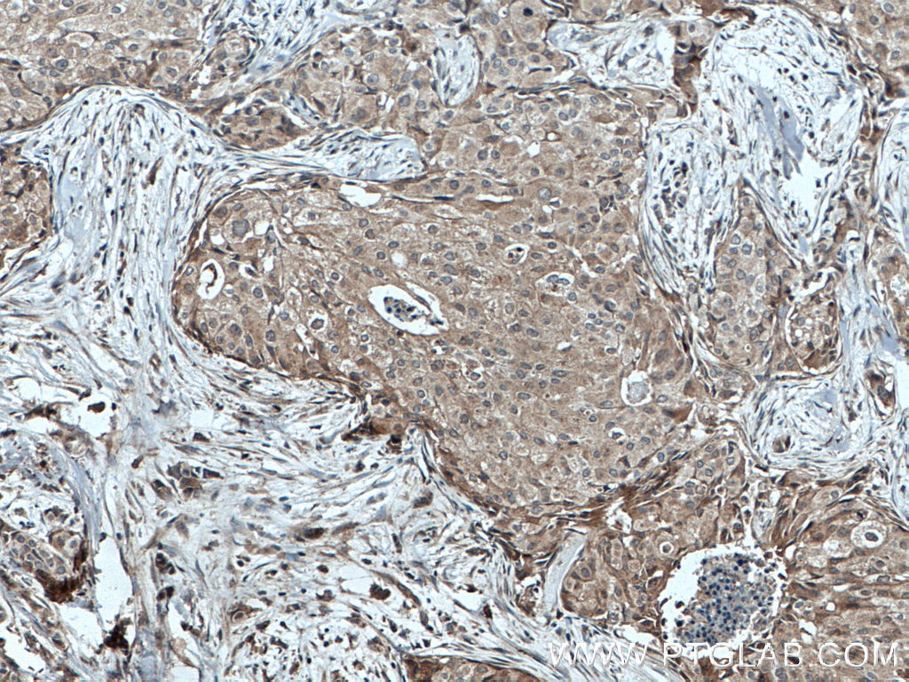 IHC staining of human breast cancer using 55443-1-AP