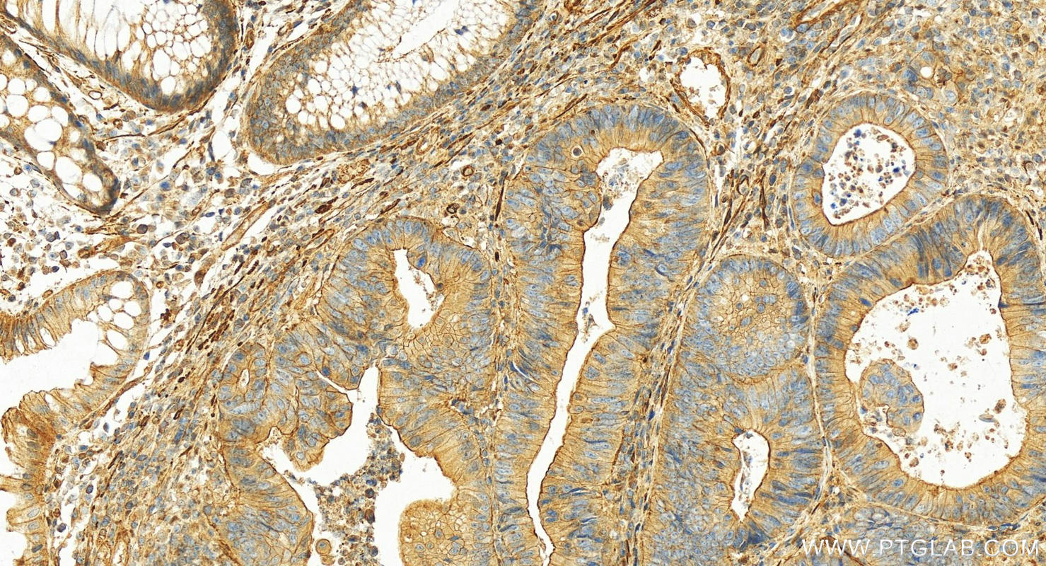 IHC staining of human colon cancer using 10737-1-AP