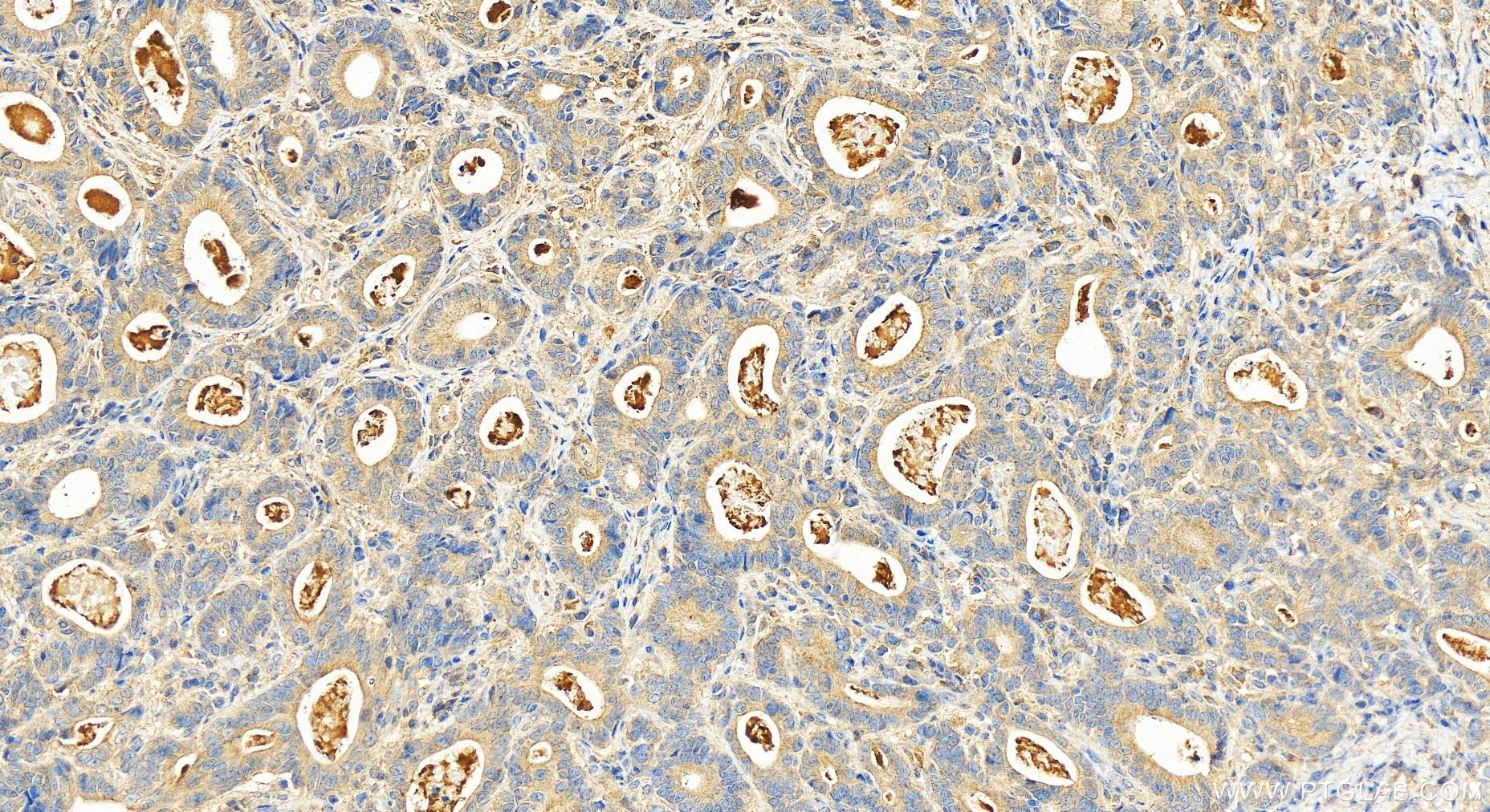 IHC staining of human stomach cancer using 15057-1-AP