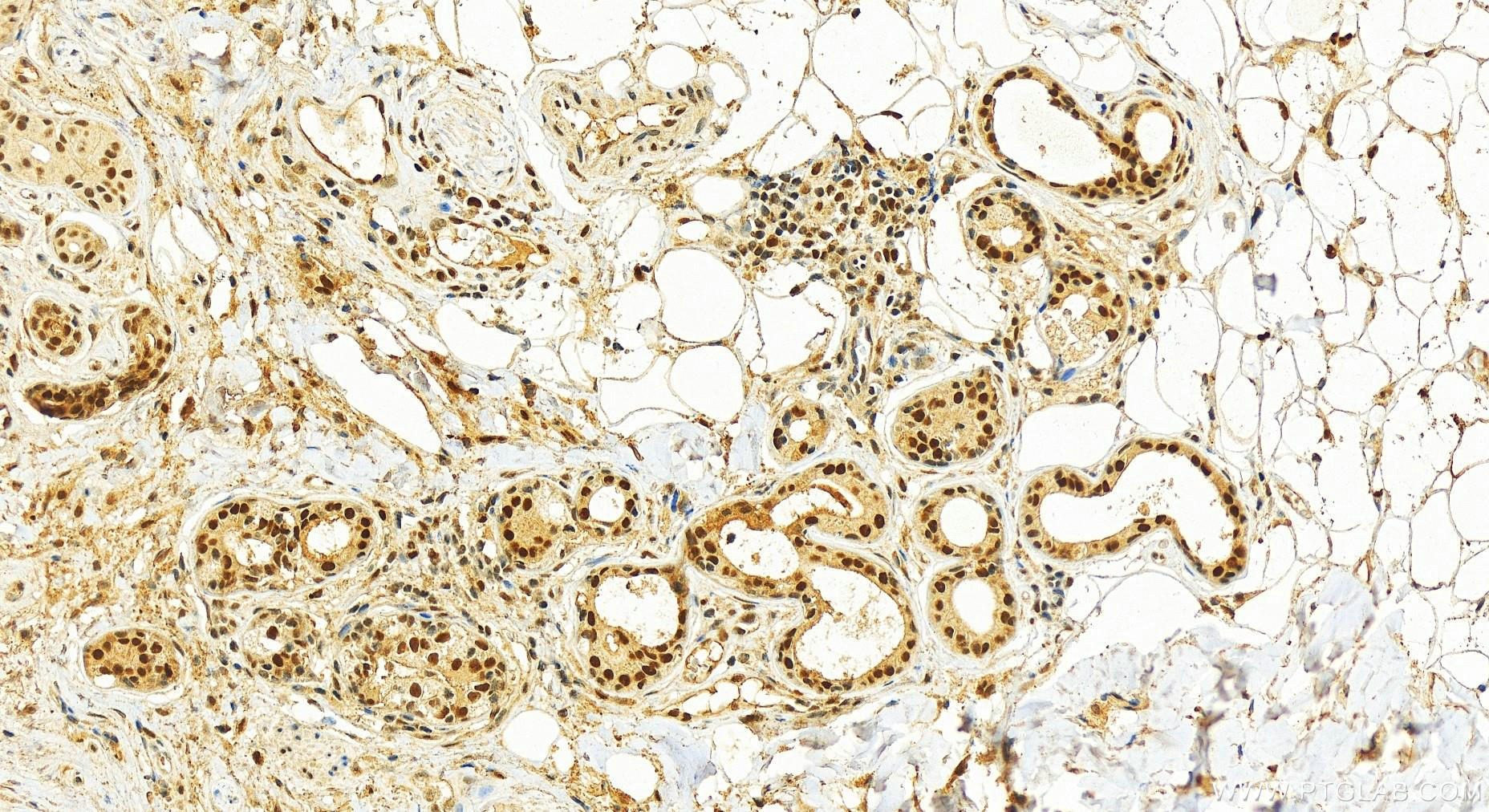 IHC staining of human skin cancer using 66402-1-Ig (same clone as 66402-1-PBS)