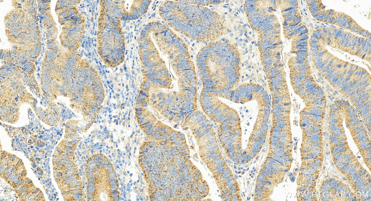 IHC staining of human colon cancer using 10824-1-AP