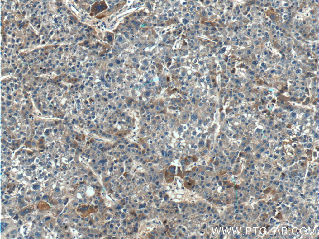 IHC staining of human liver cancer using 25120-1-AP