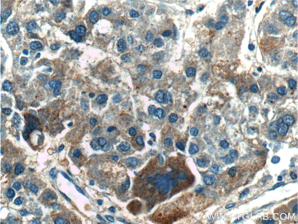 IHC staining of human liver cancer using 25120-1-AP