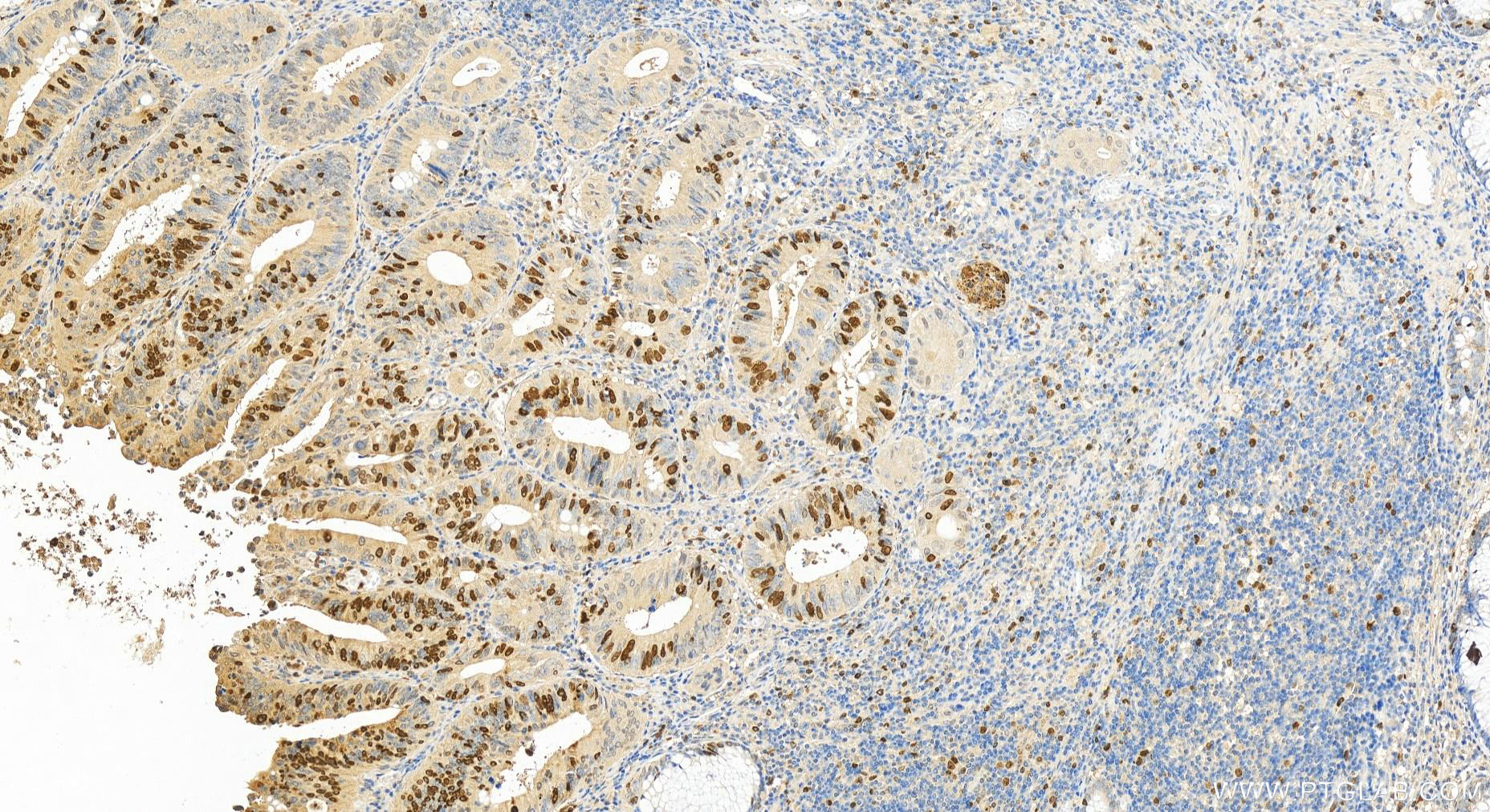 IHC staining of human colon cancer using 11741-1-AP