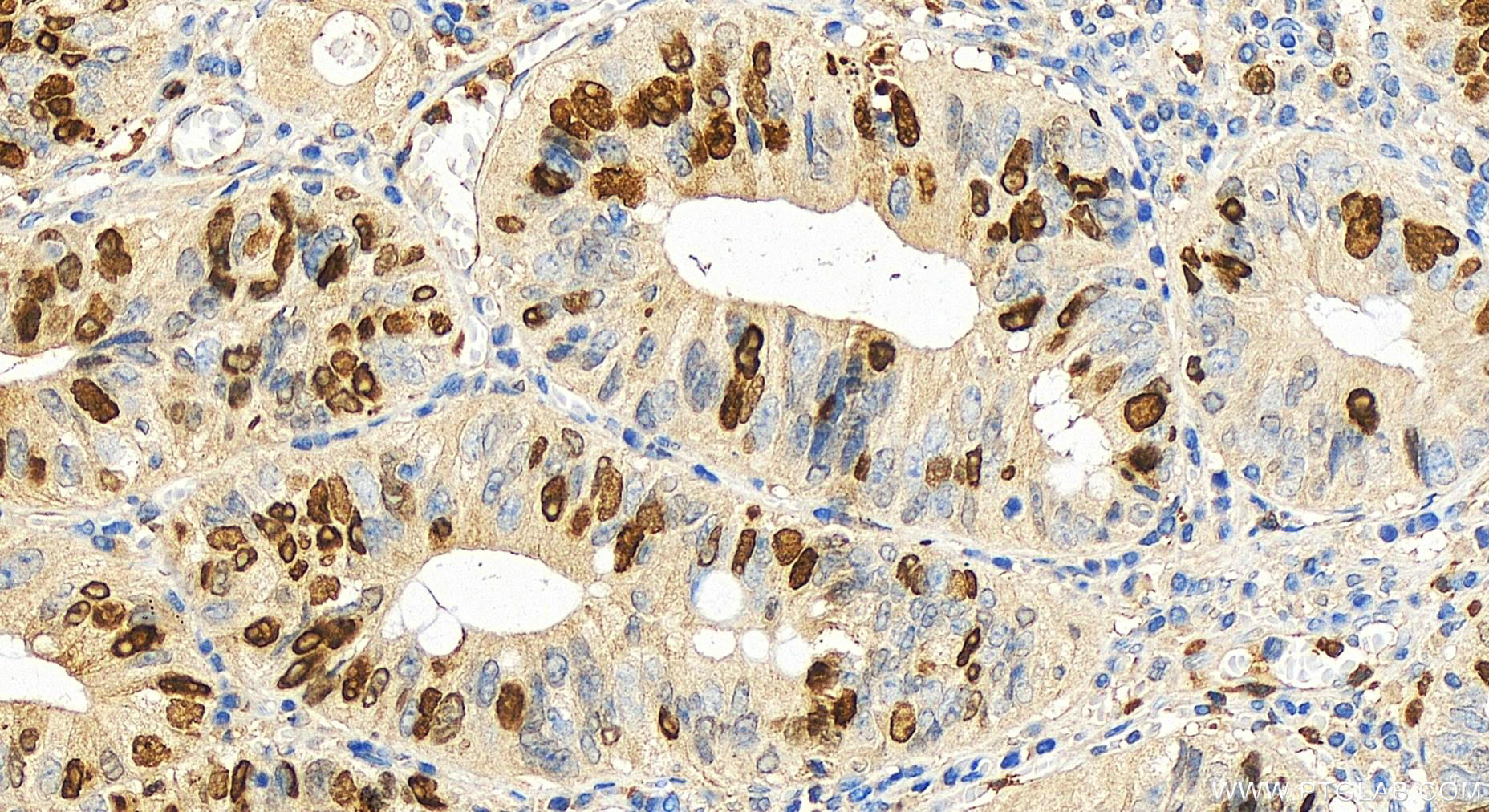 IHC staining of human colon cancer using 11741-1-AP