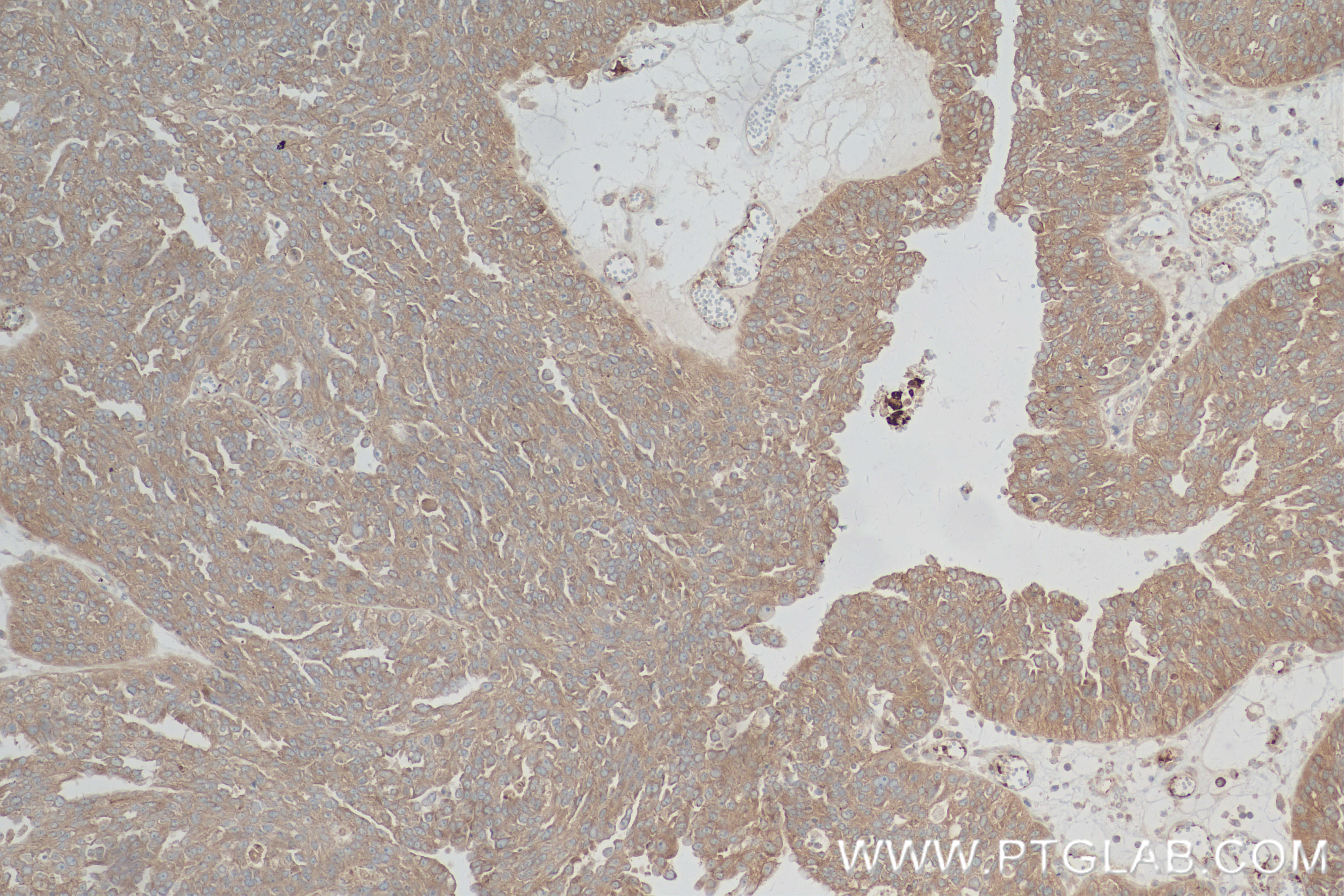 IHC staining of human ovary cancer using 84581-3-RR (same clone as 84581-3-PBS)