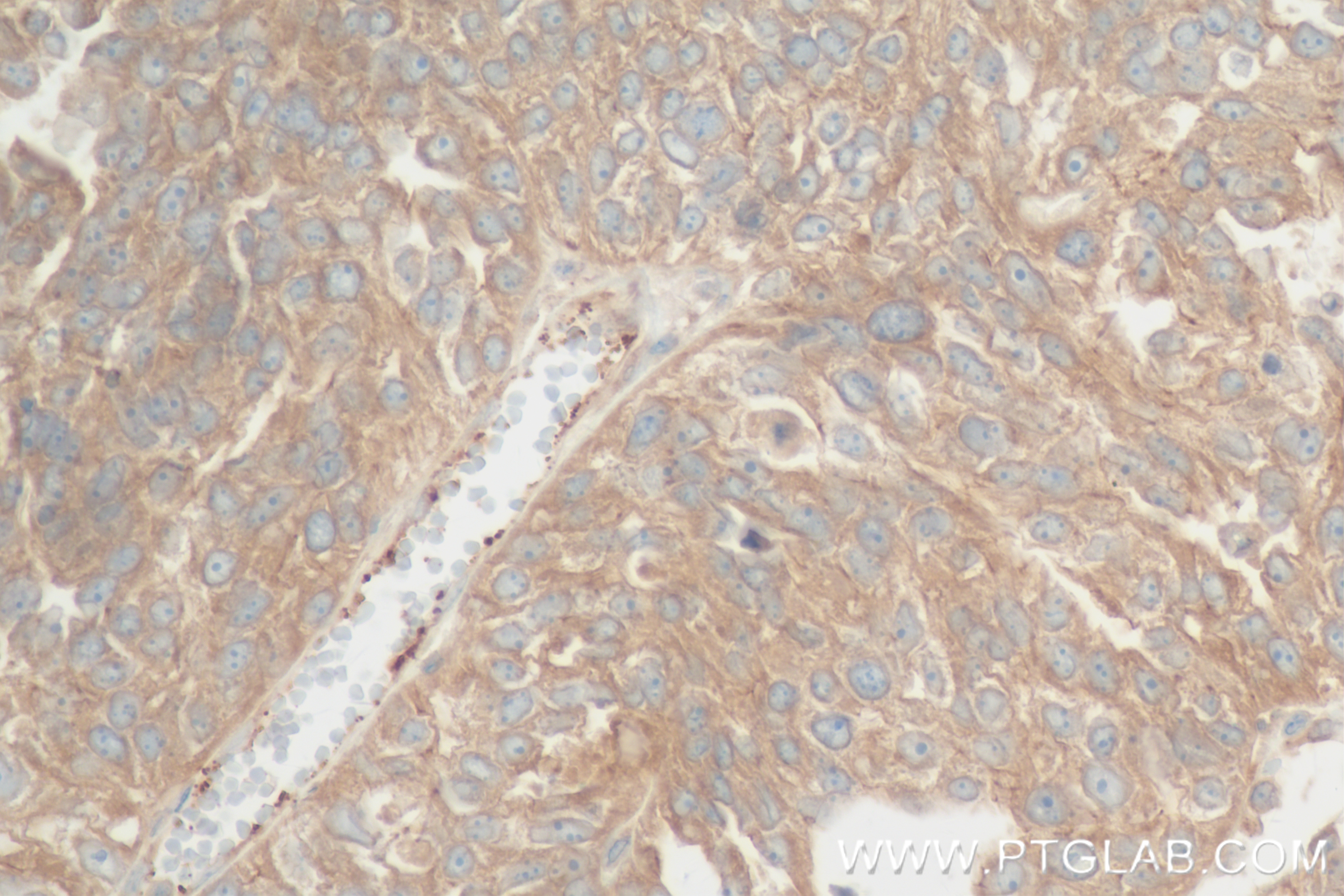 IHC staining of human ovary cancer using 84581-3-RR (same clone as 84581-3-PBS)