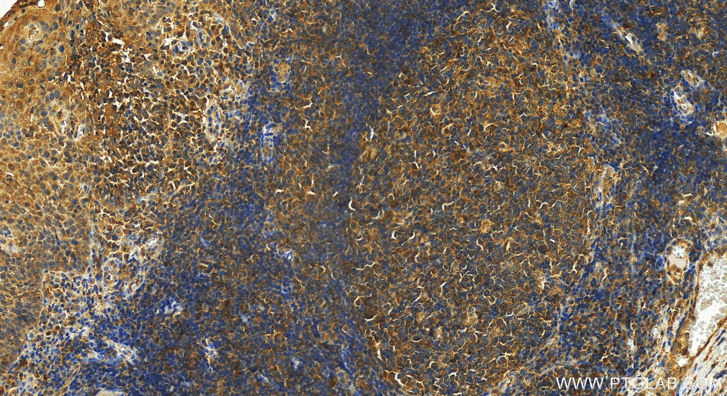 IHC staining of human tonsillitis using 27741-1-AP