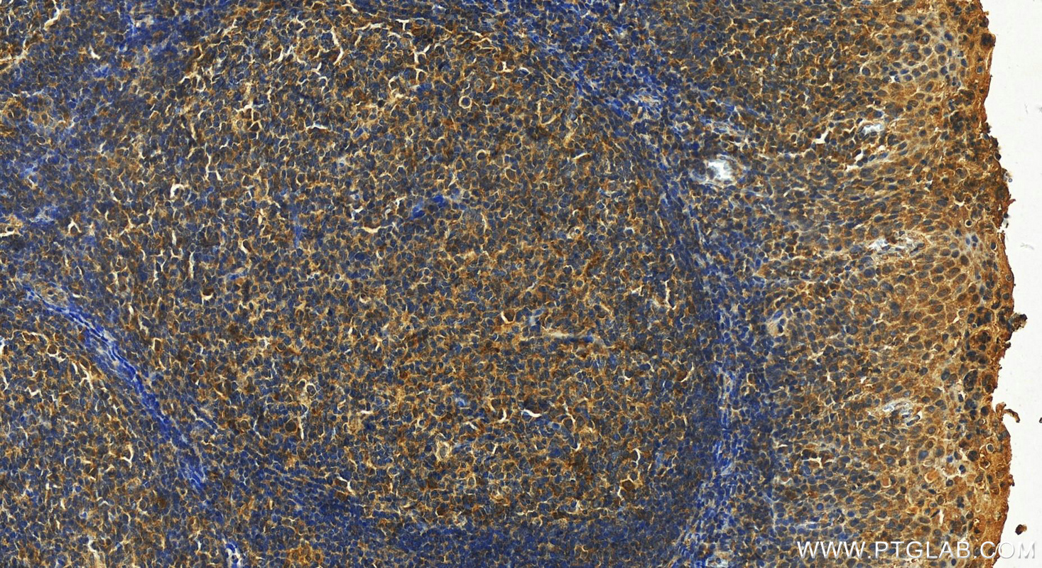 IHC staining of human tonsillitis using 27741-1-AP