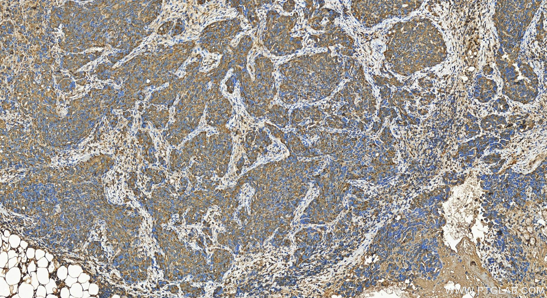 IHC staining of human ovary cancer using 27583-1-AP