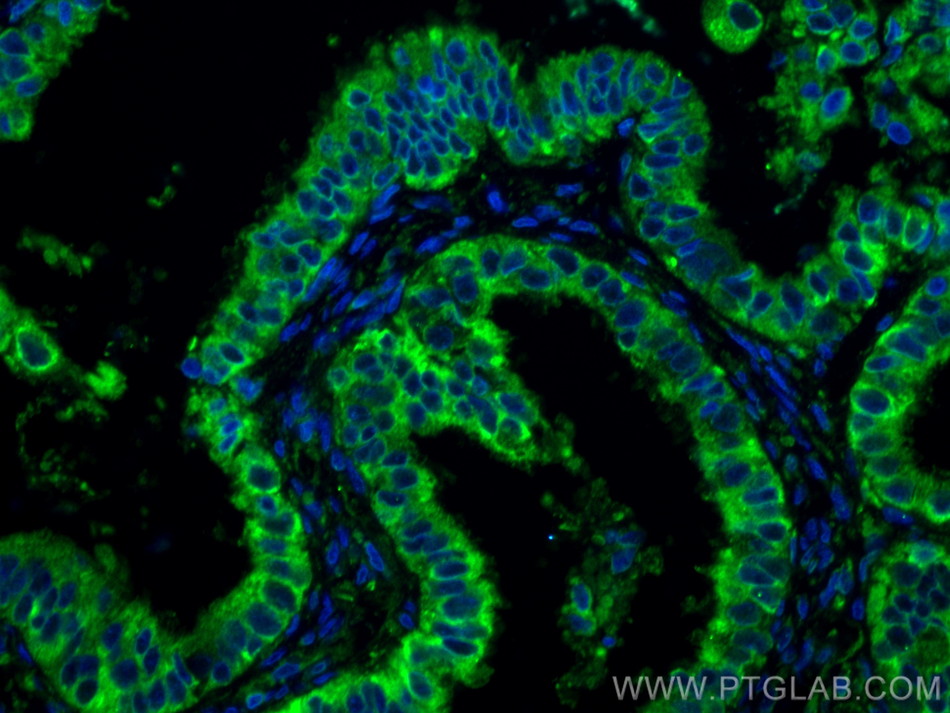 IF Staining of human ovary tumor using 67925-1-Ig