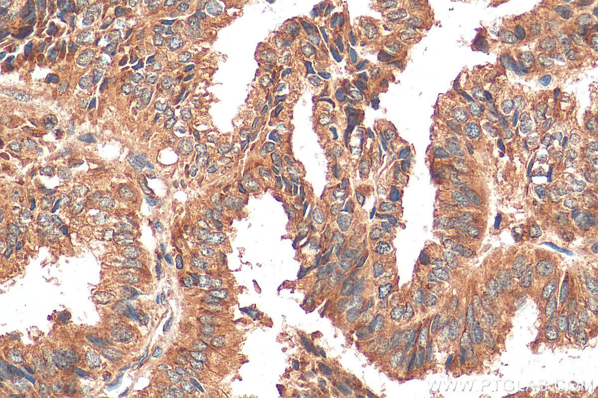 IHC staining of human ovary tumor using 67925-1-Ig