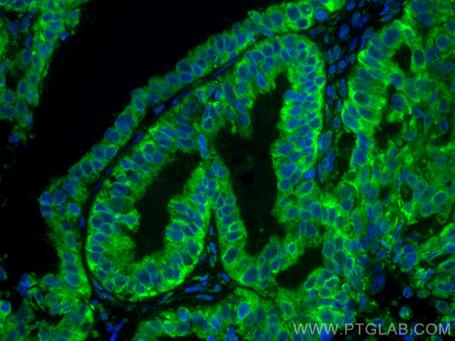 IF Staining of human ovary tumor using CL488-67925