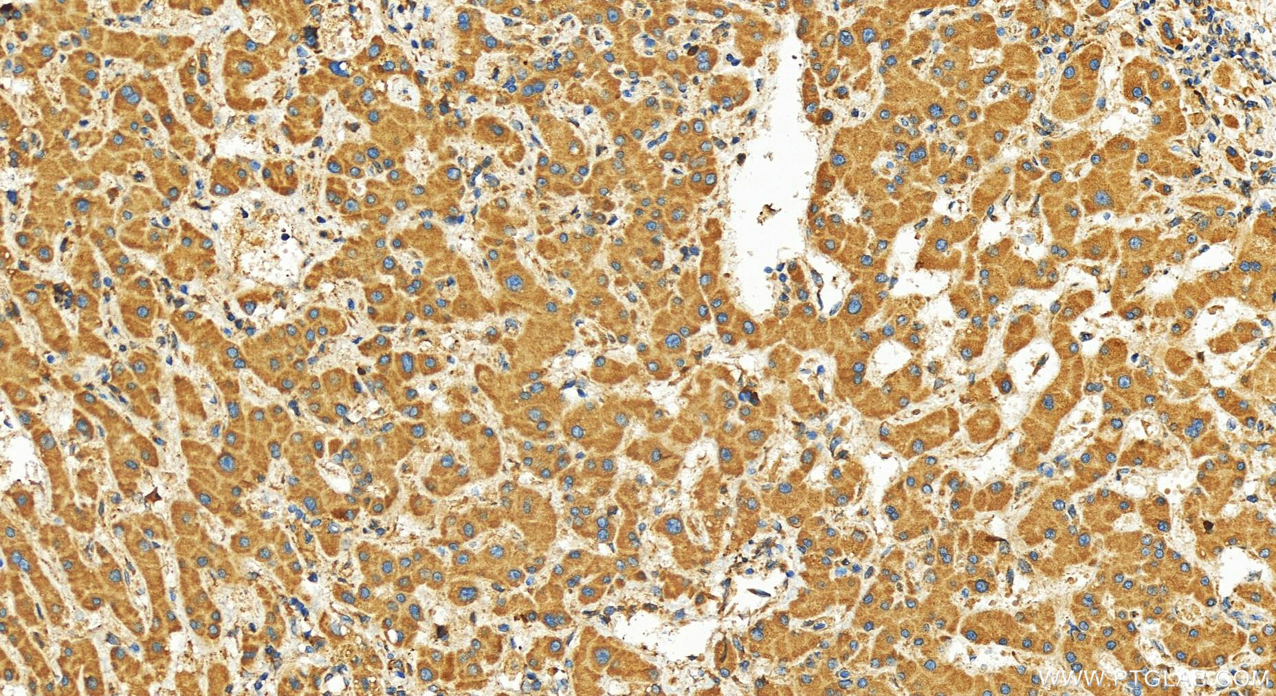 IHC staining of human intrahepatic cholangiocarcinoma using 27774-1-AP