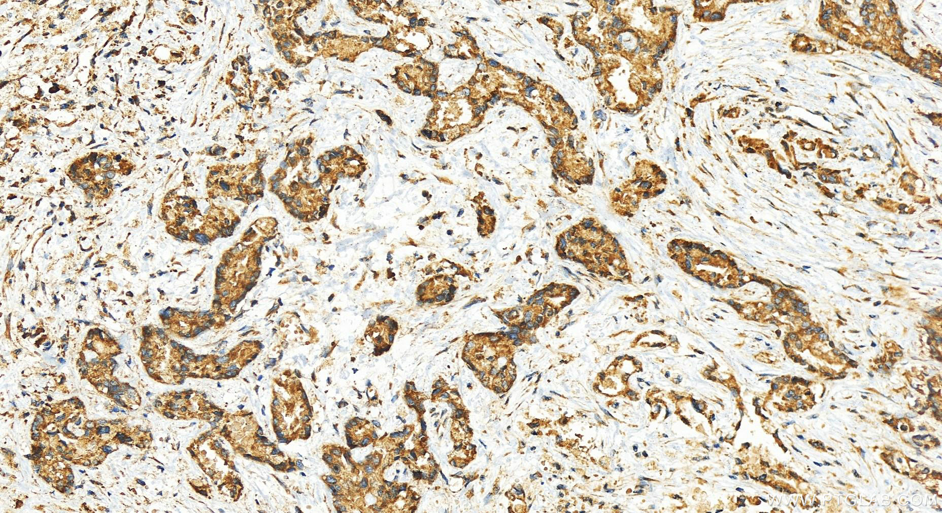 IHC staining of human intrahepatic cholangiocarcinoma using 27774-1-AP