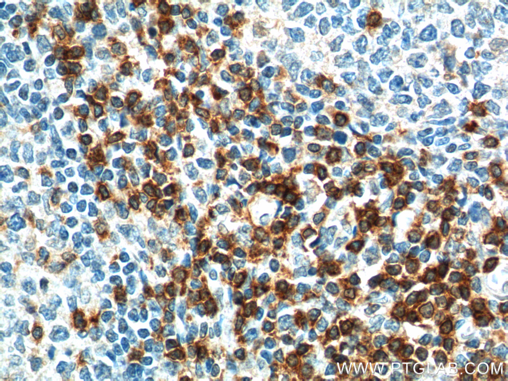 IHC staining of human tonsillitis using 13279-1-AP