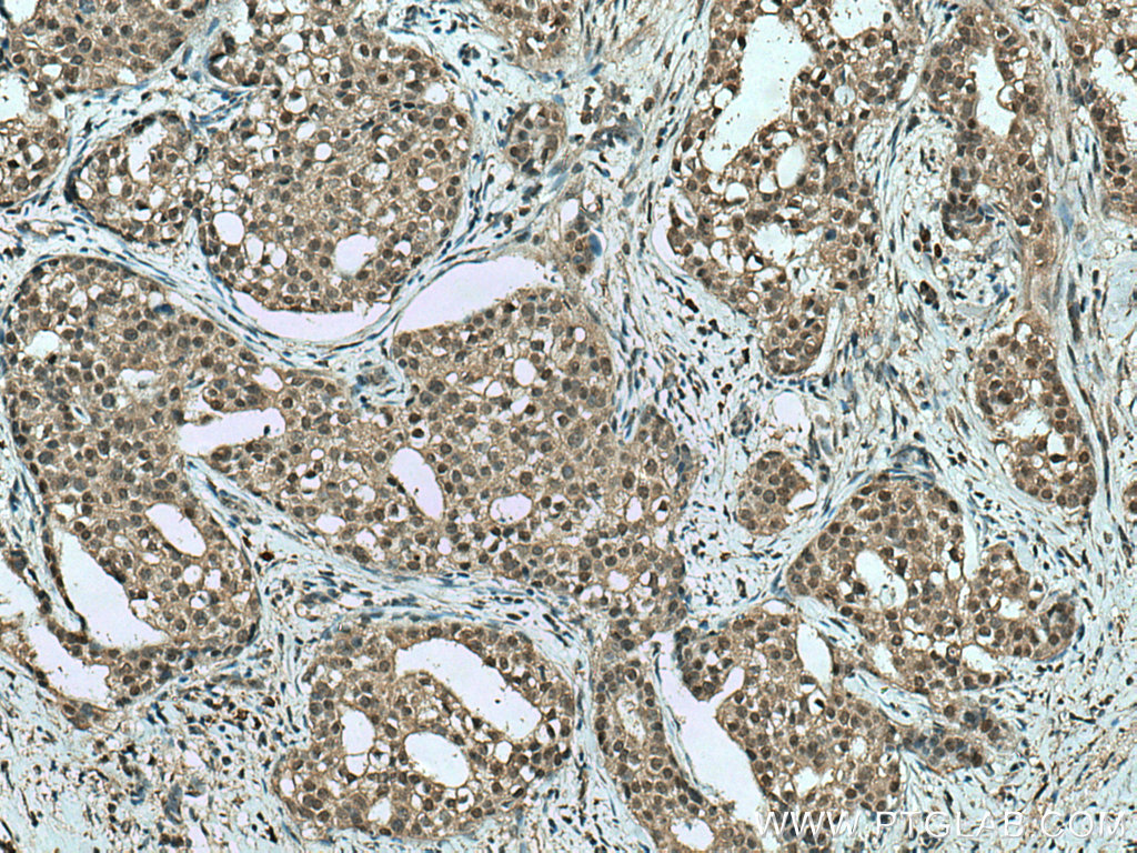 IHC staining of human breast cancer using 66792-1-Ig (same clone as 66792-1-PBS)