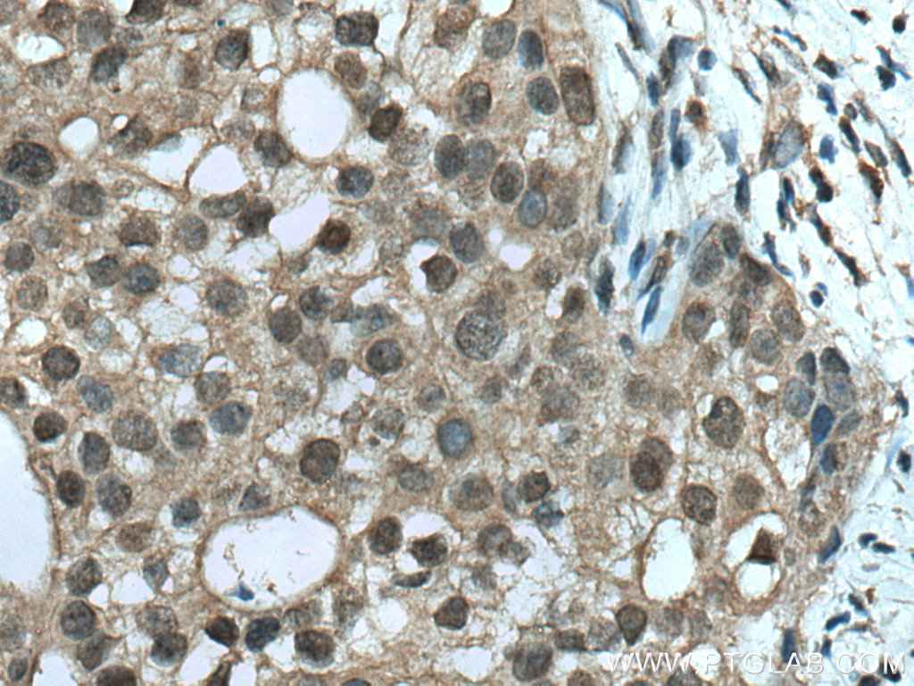 IHC staining of human breast cancer using 66792-1-Ig (same clone as 66792-1-PBS)