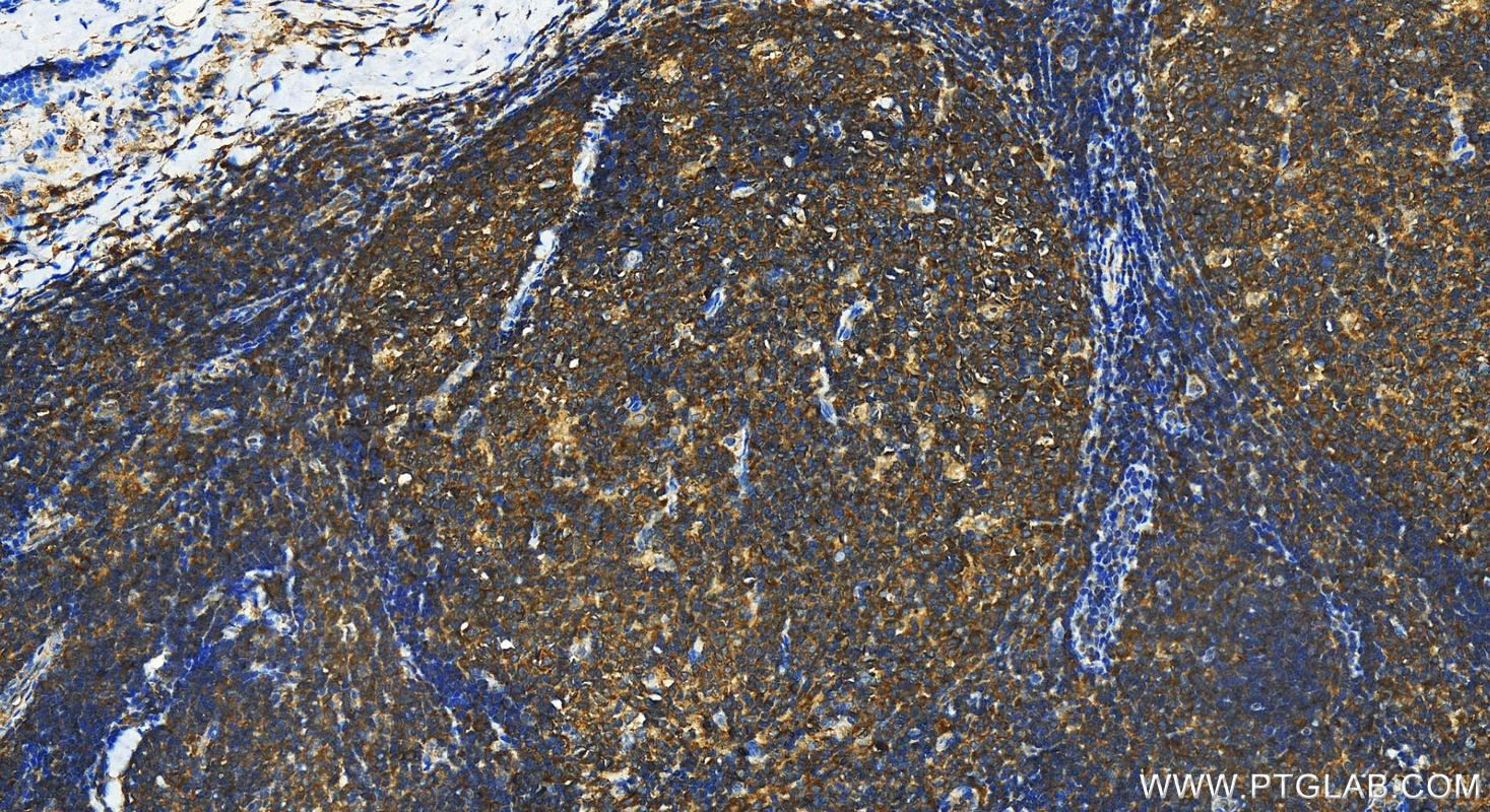 IHC staining of human tonsillitis using 11791-1-AP