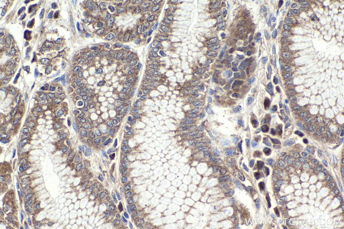 IHC staining of human stomach cancer using 13623-1-AP