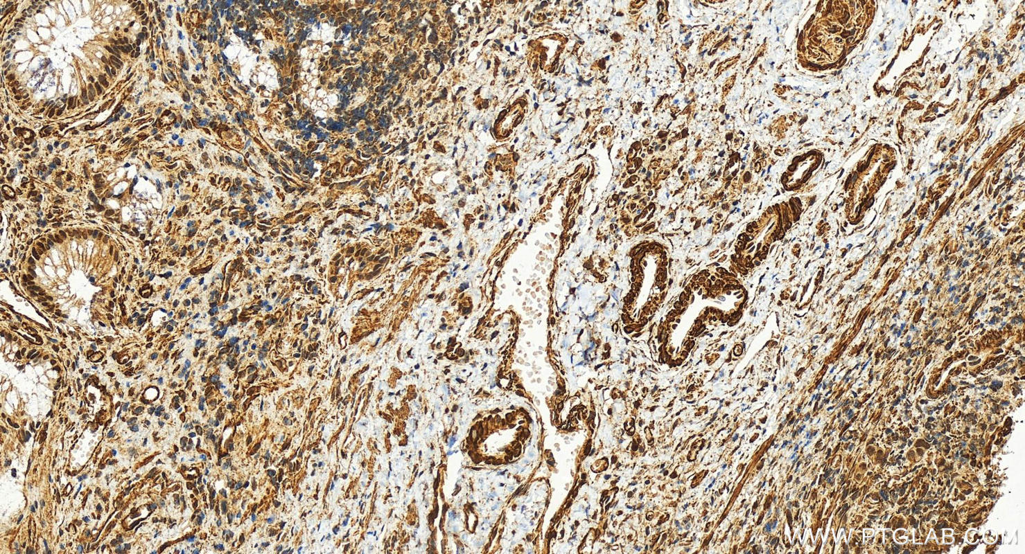 IHC staining of human colon cancer using 83530-3-RR