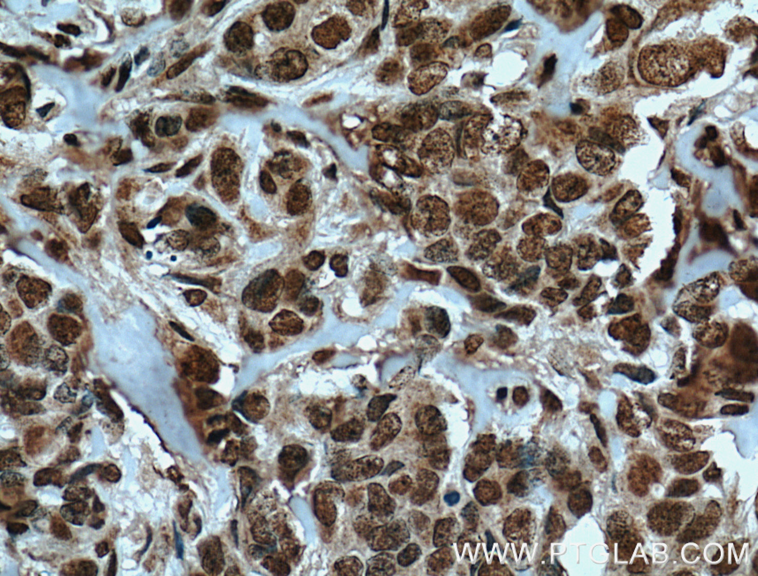 IHC staining of human breast cancer using 66324-1-Ig