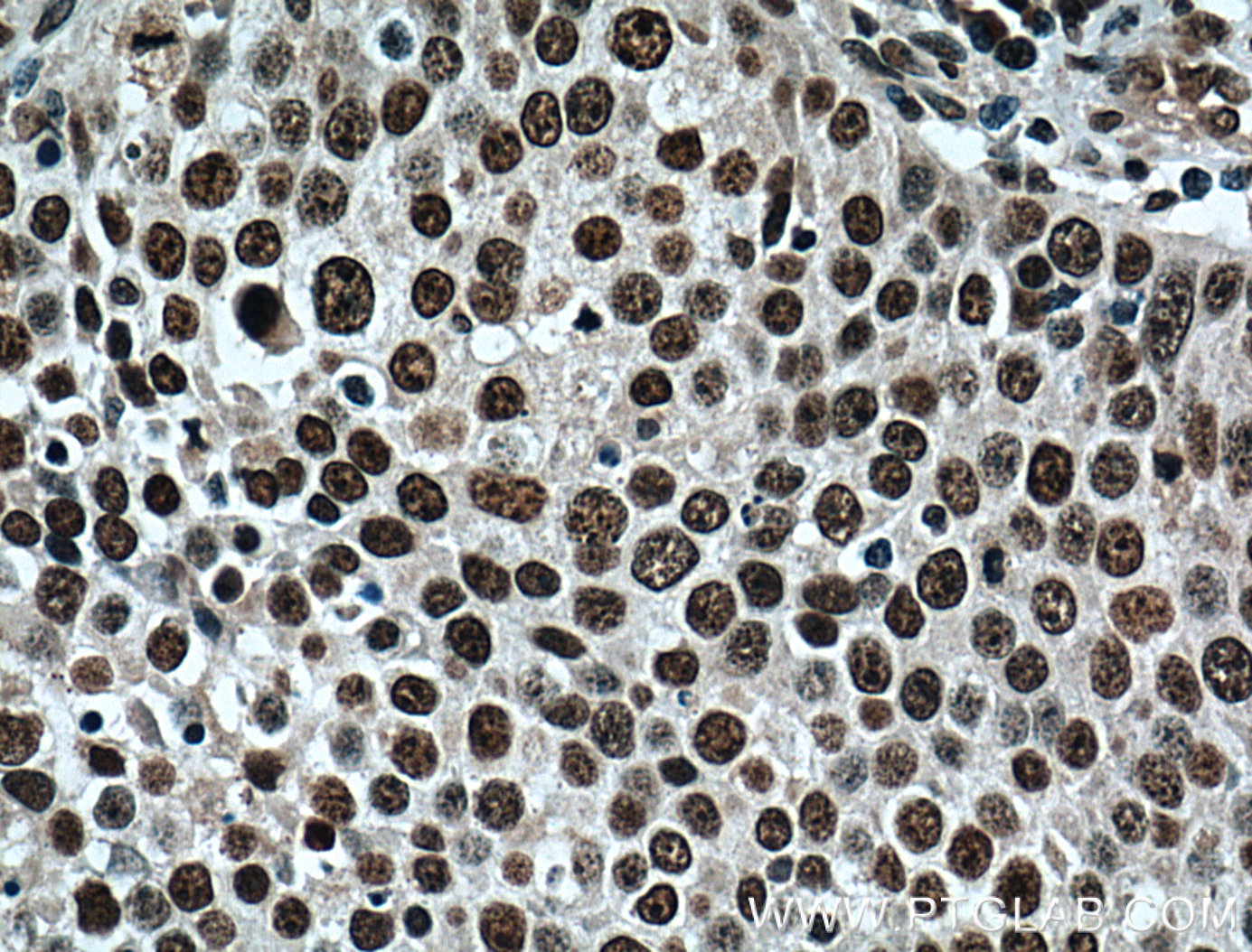 IHC staining of human lung cancer using 66324-1-Ig