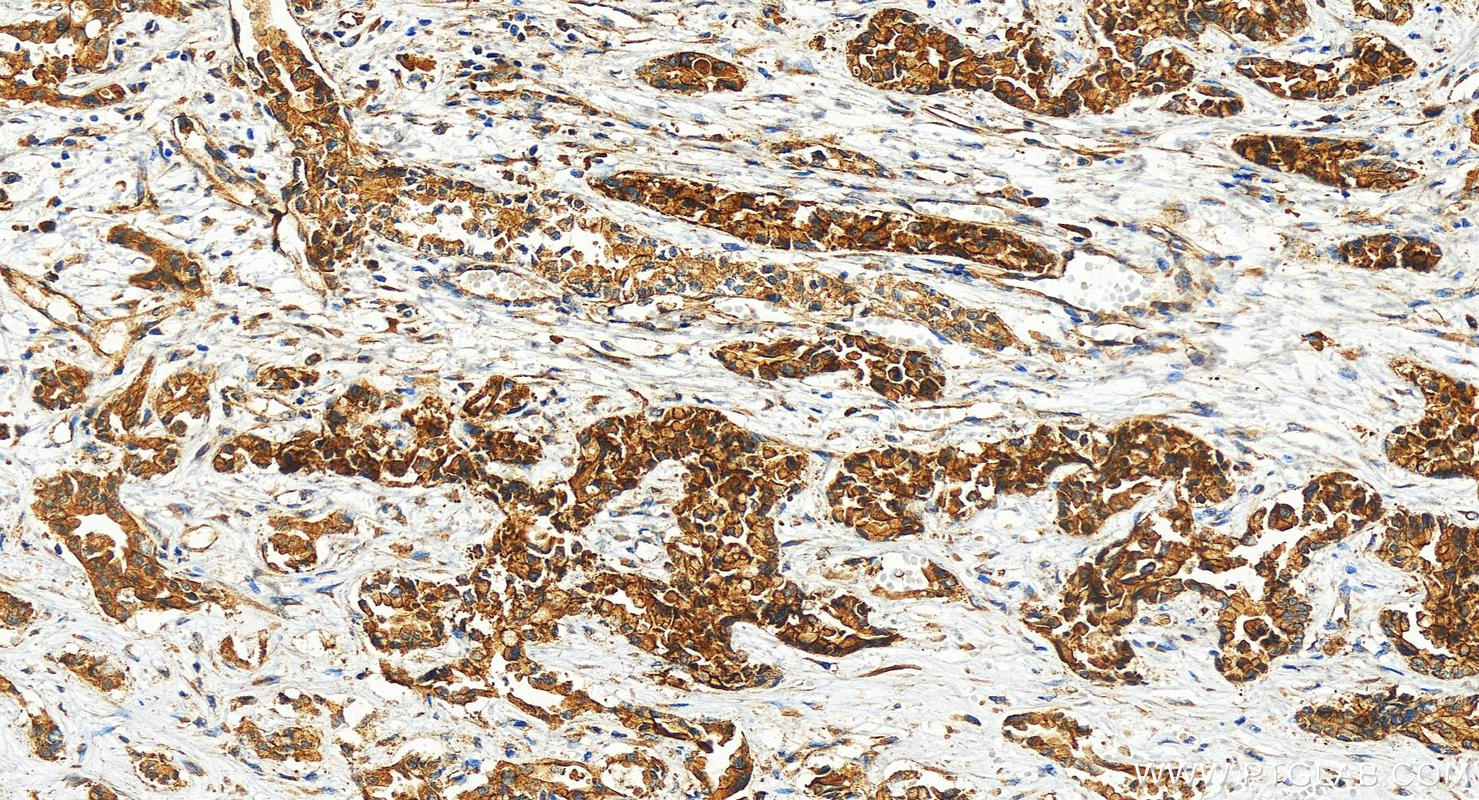 IHC staining of human intrahepatic cholangiocarcinoma using 28392-1-AP