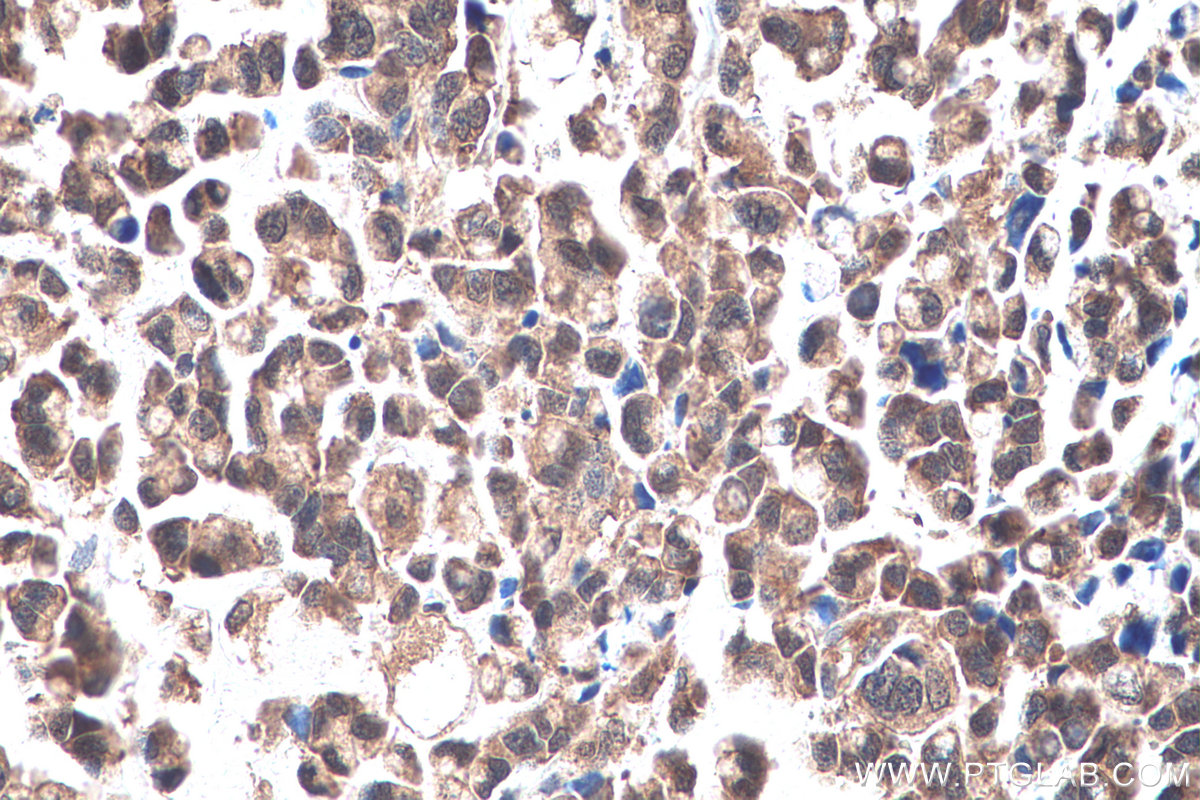 IHC staining of human colon cancer using 26885-1-AP