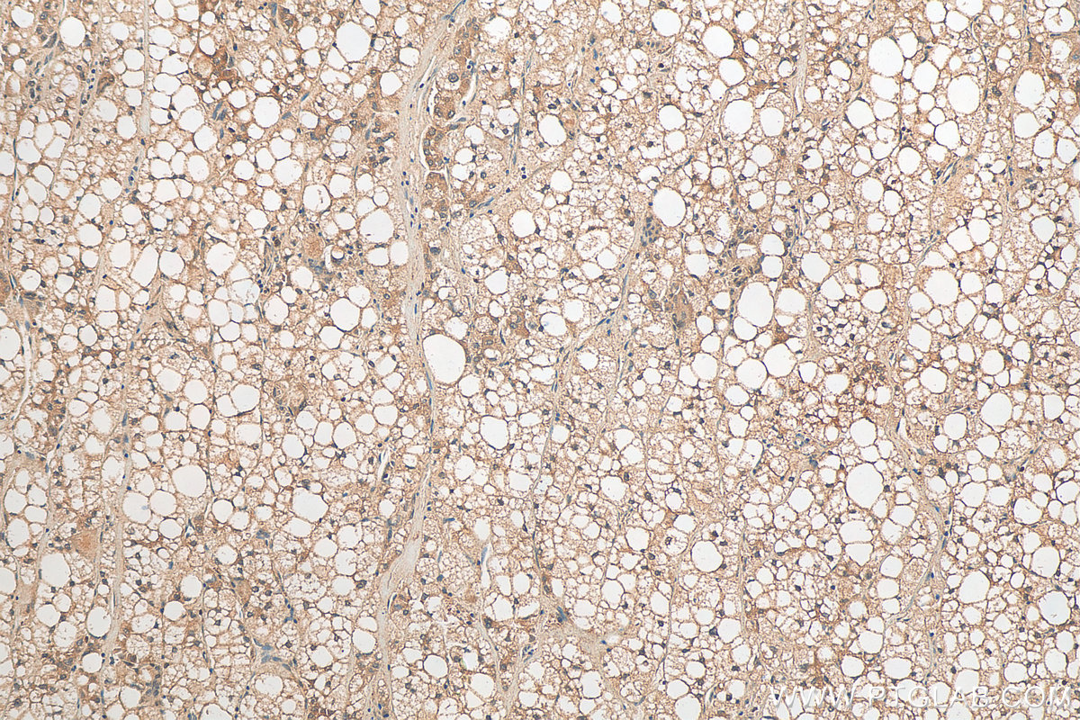 IHC staining of human liver cancer using 12324-1-AP